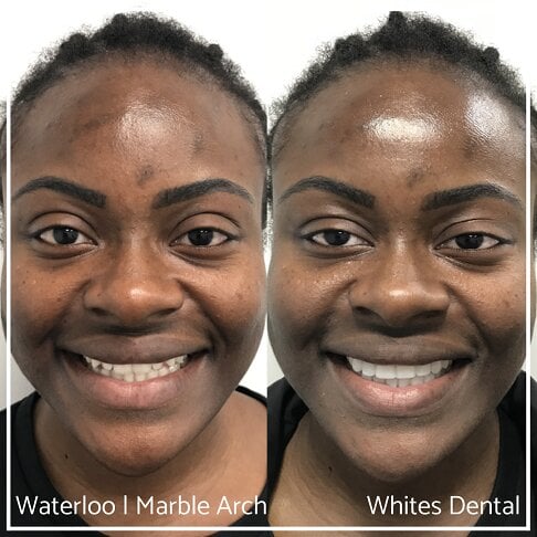 Composite Bonding Before And After Cosmetic Dentist In London 11