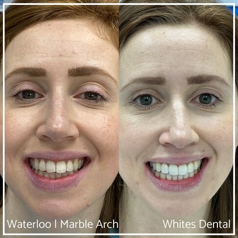 Composite Bonding Before And After Cosmetic Dentist In London 12