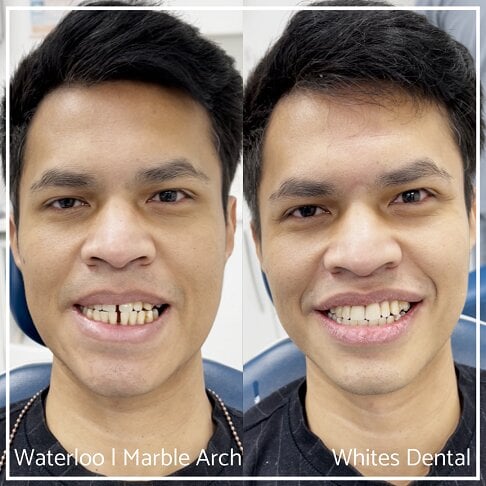 Composite Bonding Before And After Cosmetic Dentist In London Gaps In Smile 13