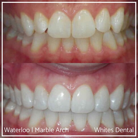 Composite Bonding Before And After Crooked Teeth Cosmetic Dentist London 1