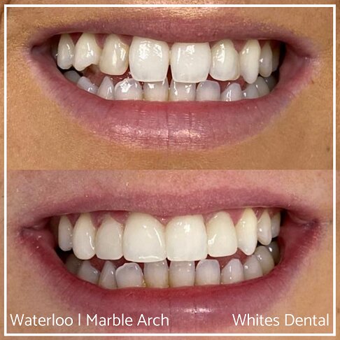 Composite Bonding Before And After Crooked Teeth Cosmetic Dentist London 3