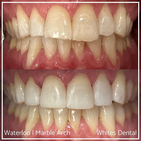Composite Bonding Before And After Front Teeth Cosmetic Dentist London 1