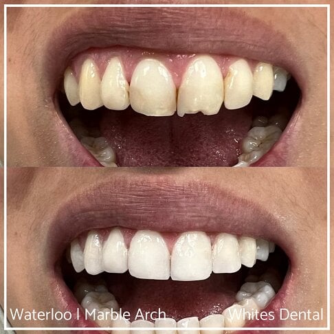Composite Bonding Before And After Front Teeth Cosmetic Dentist London 2