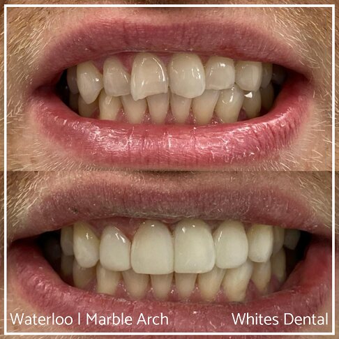 Composite Bonding Before And After Front Teeth Cosmetic Dentist London 3