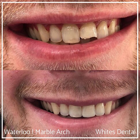 Composite Bonding Before And After Front Teeth Cosmetic Dentist London 4