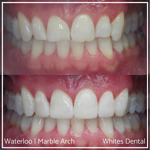 Composite Bonding Before And After Front Teeth Cosmetic Dentist London 5