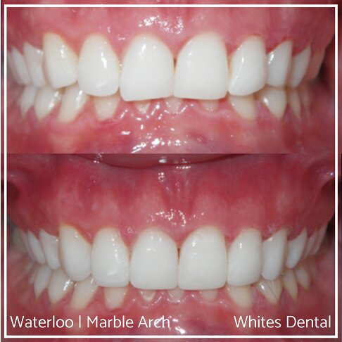 Composite Bonding Before And After Front Teeth Cosmetic Dentist London 6