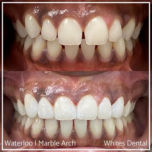 Composite Bonding Before And After Gaps In Teeth Cosmetic Dentist London 1