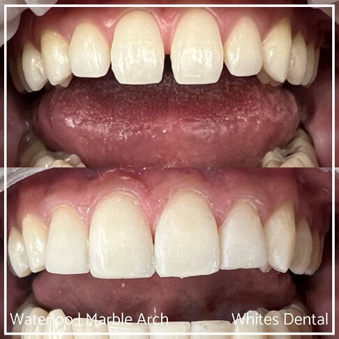 Composite Bonding Before And After Gaps In Teeth Cosmetic Dentist London 2