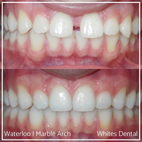 Composite Bonding Before And After Gaps In Teeth Cosmetic Dentist London 4