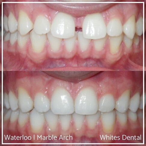 Composite Bonding Before And After Gaps In Teeth Cosmetic Dentist London 4