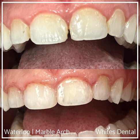 Composite Bonding Before And After Gaps In Teeth Cosmetic Dentist London 6