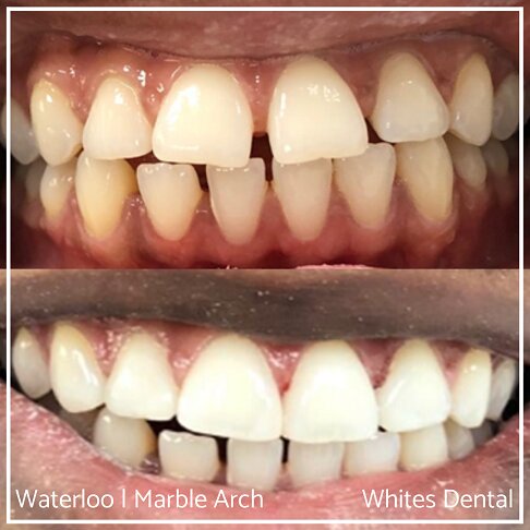 Composite Bonding Before And After Gaps In Teeth Cosmetic Dentist London 8