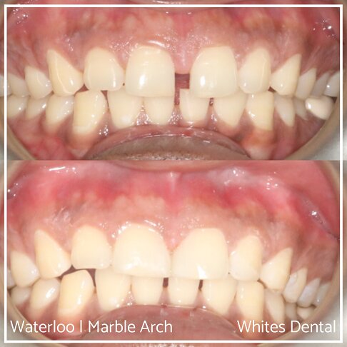 Composite Bonding Before And After Gaps In Teeth Cosmetic Dentist London 9