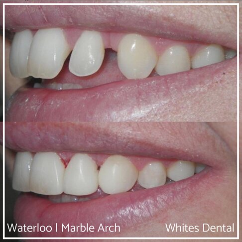 Composite Bonding Before And After Small Teeth Cosmetic Dentist London 2
