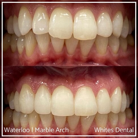 Composite Edge Bonding Before And After Cosmetic Dentist London 1