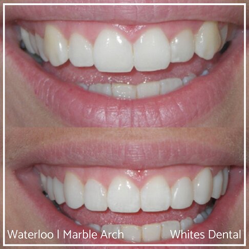 Composite Edge Bonding Before And After Cosmetic Dentist London 2