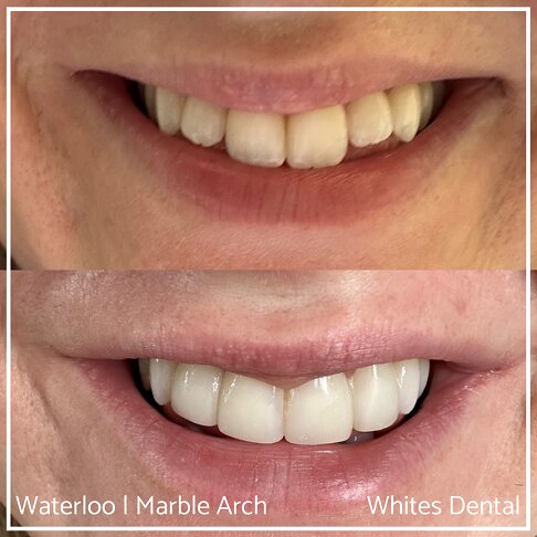 Composite Edge Bonding Before And After Cosmetic Dentist London 4