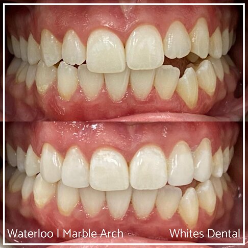 Composite Edge Bonding Before And After Cosmetic Dentist London 5