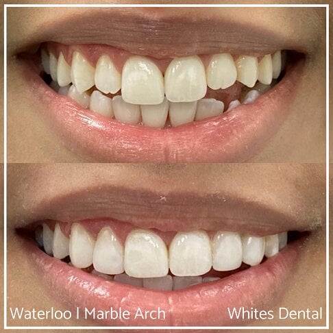 Composite Edge Bonding Before And After Cosmetic Dentist London 6