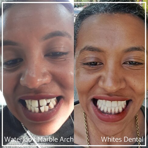 Fixed Braces Before And After Orthodontist In London 1