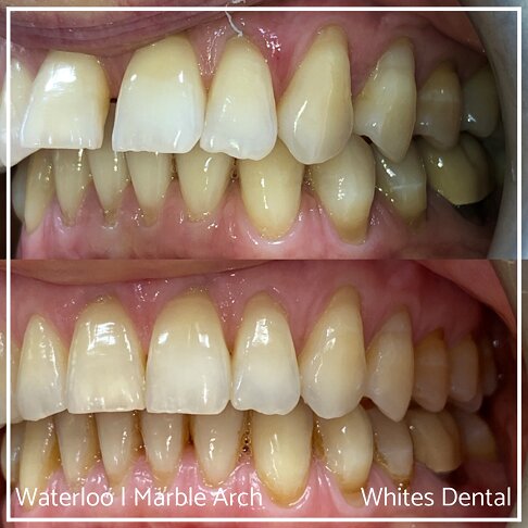 Fixed Braces Before And After Orthodontist In London 11