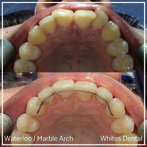 Fixed Braces Before And After Orthodontist In London 13