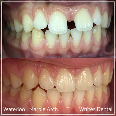 Fixed Braces Before And After Orthodontist In London 14