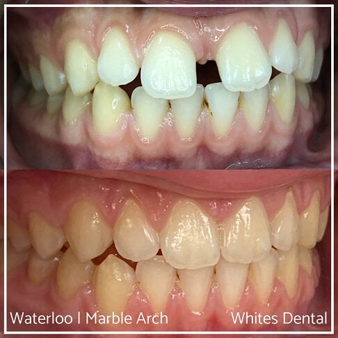 Fixed Braces Before And After Orthodontist In London 14