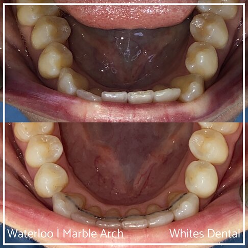 Fixed Braces Before And After Orthodontist In London 15