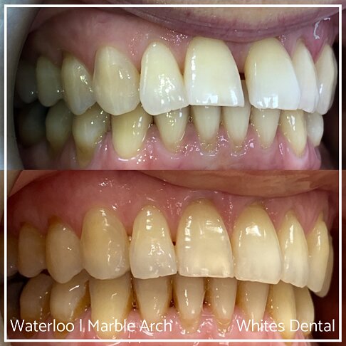 Fixed Braces Before And After Orthodontist In London 16
