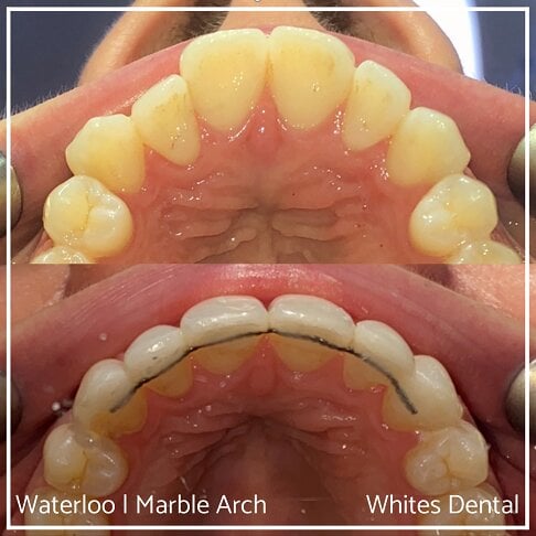 Fixed Braces Before And After Orthodontist In London 18