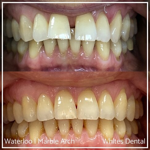 Fixed Braces Before And After Orthodontist In London Waterloo and Marble Arch