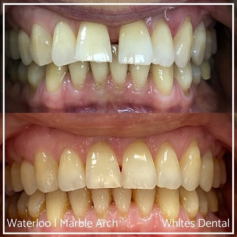 Fixed Braces Before And After Orthodontist In London 3