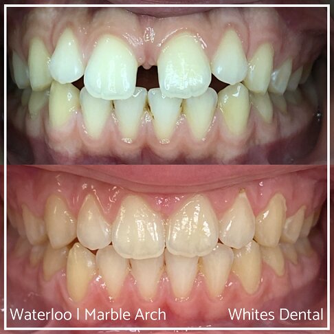 Fixed Braces Before And After Orthodontist In London 4