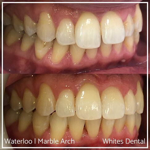Fixed Braces Before And After Orthodontist In London 5