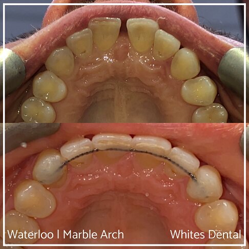Fixed Braces Before And After Orthodontist In London 7