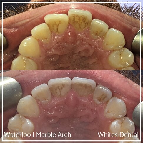 Fixed Braces Before And After Orthodontist In London 8