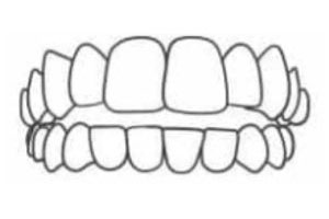 What-Issues-Can-Invisalign-Fix-Open-Bite