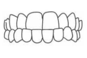What-Issues-Can-Invisalign-Fix-Under-Bite