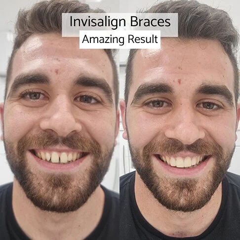 Invisalign cost London – a before and after image for Invisalign