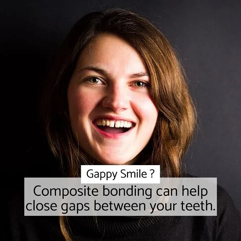 Gappy smile can be corrected by our dentist in London Waterloo