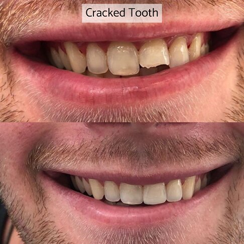 Composite Bonding London - Chipped Cracked Tooth