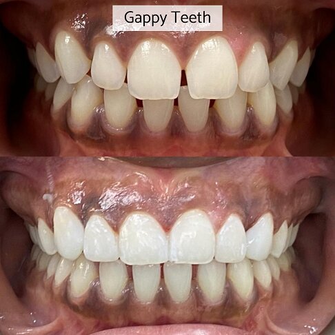 Composite Bonding London - Gappy Teeth