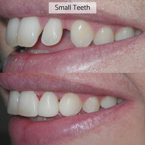 Composite Bonding London - Reshape Teeth