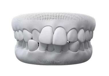 What issues can Invisalign fix – crooked crowded teeth