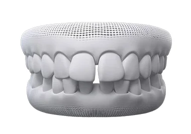 What issues can Invisalign fix – gapped teeth