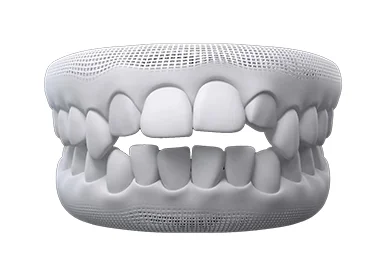 What issues can Invisalign fix – open bite