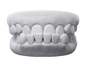 What issues can Invisalign fix – under bite
