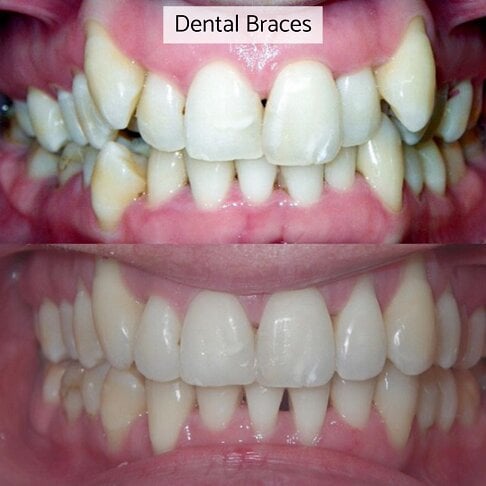 Dental braces cost in London